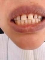 Decayed and misaligned teeth affecting dental health and appearance.